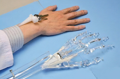 人工關(guān)節(jié)