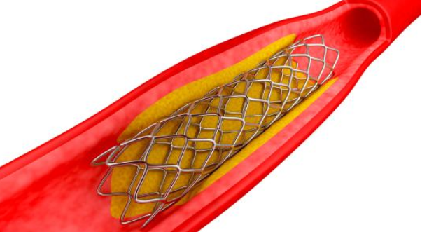 低溫等離子表面處理技術(shù)對(duì)心血管支架藥物涂層均勻性和牢固度提升-普樂斯等離子清洗機(jī)