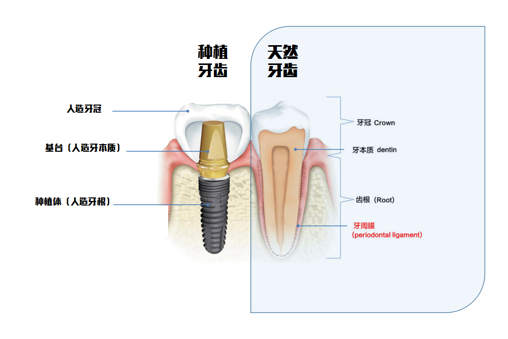 種植牙結(jié)構(gòu)